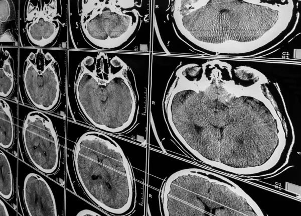 A number of medical scans of a person's brain in black and white.