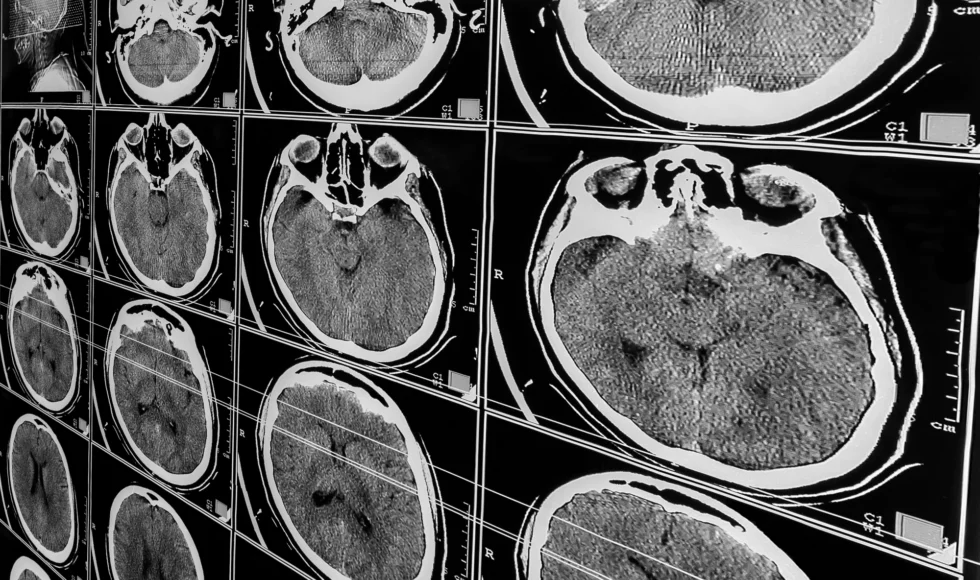 A number of medical scans of a person's brain in black and white.