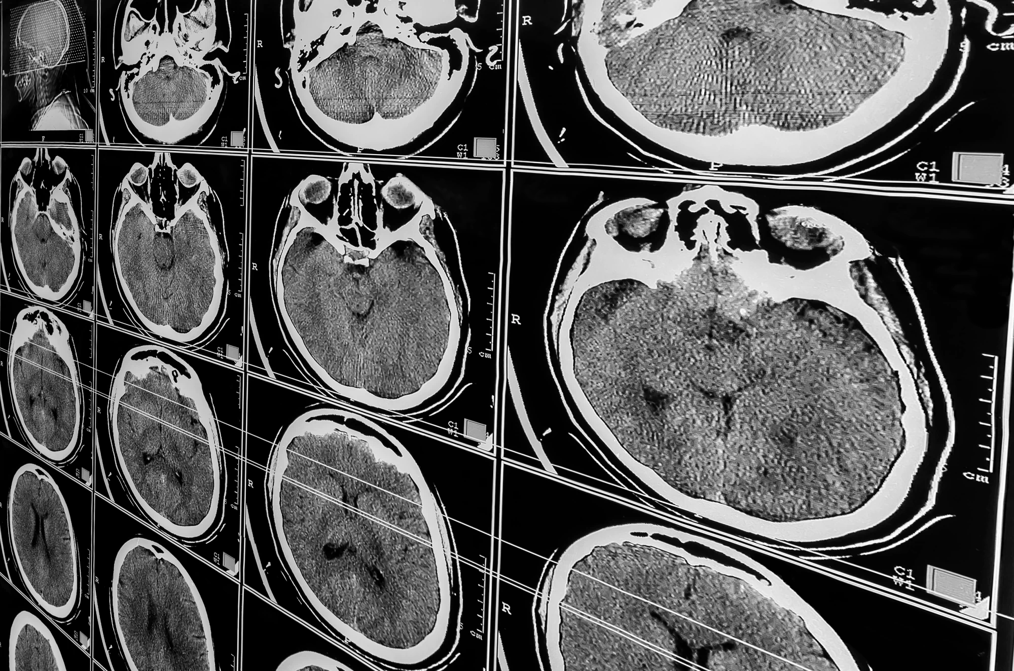 A number of medical scans of a person's brain in black and white.